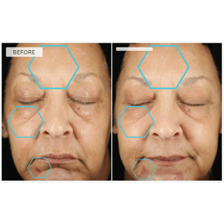 Dermaquest Advanced B5 With Ferulic Acid